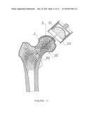 PARTIAL HIP PROSTHESIS diagram and image