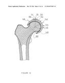 PARTIAL HIP PROSTHESIS diagram and image