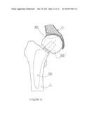 PARTIAL HIP PROSTHESIS diagram and image