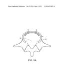 IN-SITU FORMED INTERVERTEBRAL FUSION DEVICE AND METHOD diagram and image