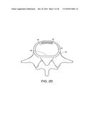 IN-SITU FORMED INTERVERTEBRAL FUSION DEVICE AND METHOD diagram and image