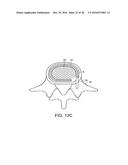 IN-SITU FORMED INTERVERTEBRAL FUSION DEVICE AND METHOD diagram and image