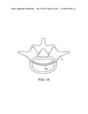 IN-SITU FORMED INTERVERTEBRAL FUSION DEVICE AND METHOD diagram and image