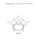 IN-SITU FORMED INTERVERTEBRAL FUSION DEVICE AND METHOD diagram and image