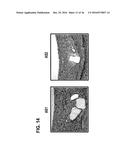 STENTS HAVING CONTROLLED ELUTION diagram and image