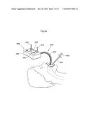 METHODS AND INSTRUMENTS FOR TREATING OBESITY diagram and image