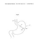 METHODS AND INSTRUMENTS FOR TREATING OBESITY diagram and image