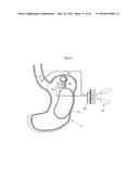 METHODS AND INSTRUMENTS FOR TREATING OBESITY diagram and image