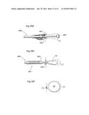 METHODS AND INSTRUMENTS FOR TREATING OBESITY diagram and image