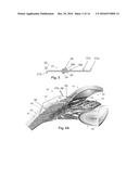 Glaucoma Device Delivery System and Trans-Conjunctival Method of Delivery diagram and image