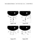 Glaucoma Device Delivery System and Trans-Conjunctival Method of Delivery diagram and image