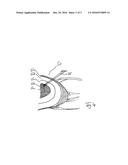 APPARATUS FOR INDIVIDUAL THERAPY PLANNING AND POSITIONALLY ACCURATE     MODIFICATION OF AN OPTICAL ELEMENT diagram and image