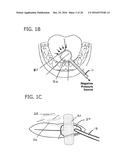 LIQUID CONTAINER AND ABSORBENT INSERT FOR ORAL NEGATIVE-PRESSURE THERAPY     SYSTEM diagram and image