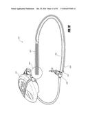 APPARATUSES AND METHODS FOR NEGATIVE PRESSURE WOUND THERAPY diagram and image