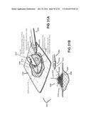 APPARATUSES AND METHODS FOR NEGATIVE PRESSURE WOUND THERAPY diagram and image