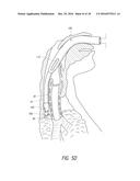 APPARATUS AND METHOD FOR IMPROVED ASSISTED VENTILATION diagram and image