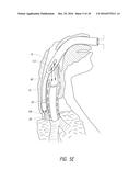 APPARATUS AND METHOD FOR IMPROVED ASSISTED VENTILATION diagram and image