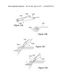 VESSEL CANNULATION DEVICE AND METHOD OF USE diagram and image