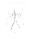 DEVICES AND METHODS FOR TREATING ACUTE KIDNEY INJURY diagram and image