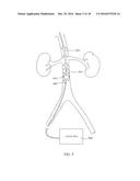 DEVICES AND METHODS FOR TREATING ACUTE KIDNEY INJURY diagram and image