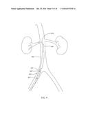 DEVICES AND METHODS FOR TREATING ACUTE KIDNEY INJURY diagram and image