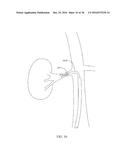 DEVICES AND METHODS FOR TREATING ACUTE KIDNEY INJURY diagram and image