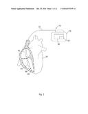 DETECTION OF DISLODGEMENT OF A DEFIBRILLATION LEAD diagram and image