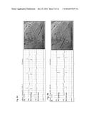 DETECTION OF DISLODGEMENT OF A DEFIBRILLATION LEAD diagram and image