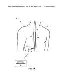 PROGRAMMING POSTURE RESPONSIVE THERAPY diagram and image