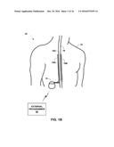 PROGRAMMING POSTURE RESPONSIVE THERAPY diagram and image