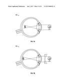 METHODS AND SYSTEMS FOR DETECTING HEALTH CONDITIONS BY IMAGING PORTIONS OF     THE EYE, INCLUDING THE FUNDUS diagram and image