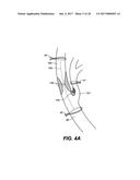 ENDOVASCULAR CATHETER WITH MULTIPLE CAPABILITIES diagram and image