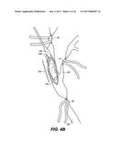 ENDOVASCULAR CATHETER WITH MULTIPLE CAPABILITIES diagram and image