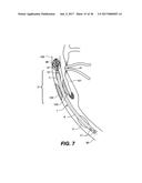 ENDOVASCULAR CATHETER WITH MULTIPLE CAPABILITIES diagram and image