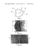 3-D VESSEL TREE SURFACE RECONSTRUCTION METHOD diagram and image