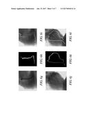 3-D VESSEL TREE SURFACE RECONSTRUCTION METHOD diagram and image