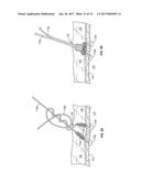 SUTURE-BASED CLOSURE WITH HEMOSTATIC TRACT PLUG diagram and image