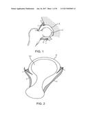 METHODS AND DEVICES TO TREAT DISEASED OR INJURED MUSCULSKELETAL TISSUE diagram and image