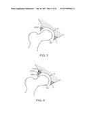 METHODS AND DEVICES TO TREAT DISEASED OR INJURED MUSCULSKELETAL TISSUE diagram and image