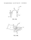 METHODS AND DEVICES TO TREAT DISEASED OR INJURED MUSCULSKELETAL TISSUE diagram and image