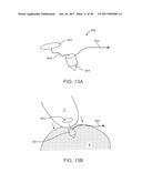 METHODS AND DEVICES TO TREAT DISEASED OR INJURED MUSCULSKELETAL TISSUE diagram and image