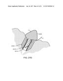 METHODS AND DEVICES TO TREAT DISEASED OR INJURED MUSCULSKELETAL TISSUE diagram and image