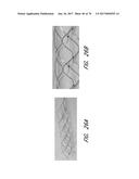 EXPANDABLE TIP ASSEMBLY FOR THROMBUS MANAGEMENT diagram and image