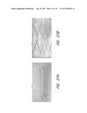 EXPANDABLE TIP ASSEMBLY FOR THROMBUS MANAGEMENT diagram and image