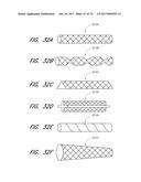 EXPANDABLE TIP ASSEMBLY FOR THROMBUS MANAGEMENT diagram and image