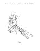 INTERSPINOUS PROCESS DEVICE AND METHOD diagram and image
