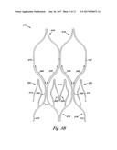 VENOUS VALVE, SYSTEM, AND METHOD WITH SINUS POCKET diagram and image