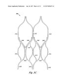 VENOUS VALVE, SYSTEM, AND METHOD WITH SINUS POCKET diagram and image