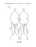 VENOUS VALVE, SYSTEM, AND METHOD WITH SINUS POCKET diagram and image