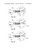 PERCUTANEOUS HEART VALVE diagram and image